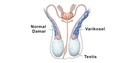 Varikosel Ameliyatı Sonrası