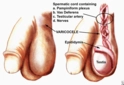 Varikosel Nasıl Anlaşılır?