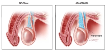 Grade 3 Varikosel Belirtileri ve Tedavisi